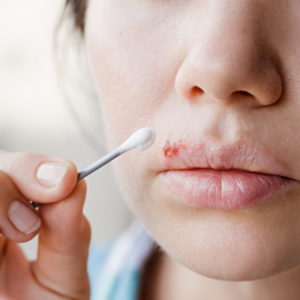 Herpes Creme auf Wattestäbchen