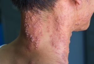 Fieberbläschen des Herpes Zoster am Hals