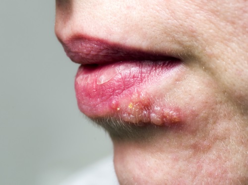 Ansteckung Archive Herpes Guru