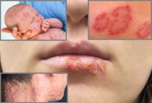 Herpestypen löschen unterschiedliche Herpesformen aus