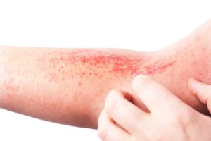 Neurodermitis: Gefahr bei Herpes